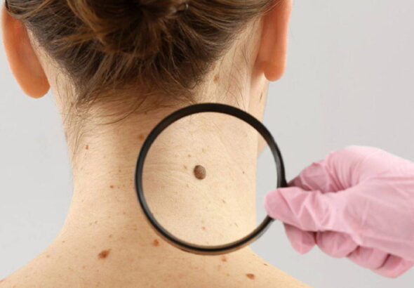 dermatoloji-uzmani-acikladi-benlerdeki-degisiklikleri-hafife-almayin-RKeriGEu